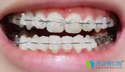 成都拜博口腔戴牙套10個月效果圖