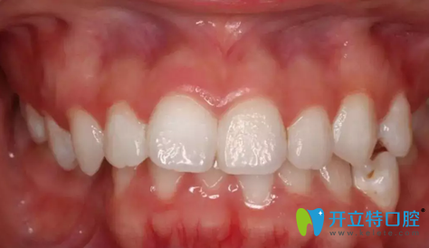 在成都拜博口腔做牙齒正畸前圖片