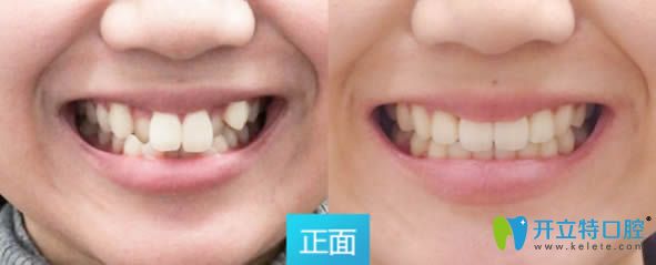 深圳拜爾口腔28歲顧客矯正牙齒前后對(duì)比照
