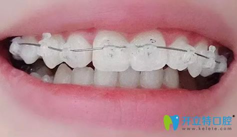 袁本瑤給我做牙齒矯正剛開始帶牙套時候樣子