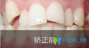 長(zhǎng)沙優(yōu)伢仕口腔齙牙矯正前