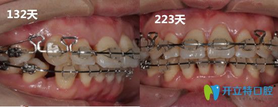 廣州圣貝口腔牙齒矯正變化過程圖