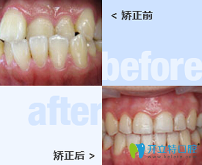 太原皓久口腔牙齒矯正前后效果對(duì)比圖