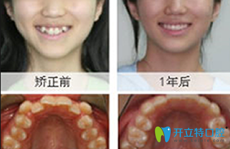 廈門登特口腔牙齒矯正前后效果對比圖
