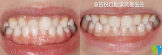 成都茁悅口腔門診6歲孩子矯正牙齒術(shù)后圖