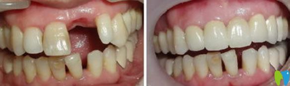 長(zhǎng)沙美奧口腔黃穎醫(yī)生種植效果圖 長(zhǎng)沙美奧口腔黃穎醫(yī)生種植效果圖