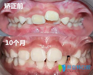 兒童MRC矯正案例對(duì)比圖