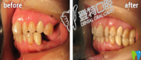 廈門登特口腔黃華生種植牙效果對(duì)比圖 廈門登特口腔黃華生種植牙效果對(duì)比圖