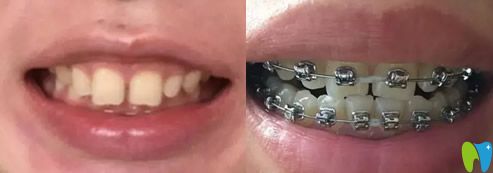 無錫北極星口腔30歲矯正牙齒前后照片 無錫北極星口腔30歲矯正牙齒前后照片