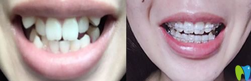 無錫臻品口腔牙齒矯正前后效果對比圖一覽