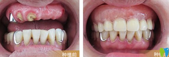 天津陽(yáng)光樹口腔張蓉種植牙效果案例