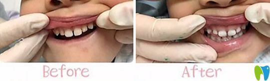 <!--<i data=20240703-sp></i>-->兒童口腔好不好？不妨看看孩子牙齒矯正案例效果
