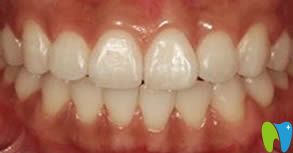 沈陽皇姑博得口腔牙齒矯正成功圖