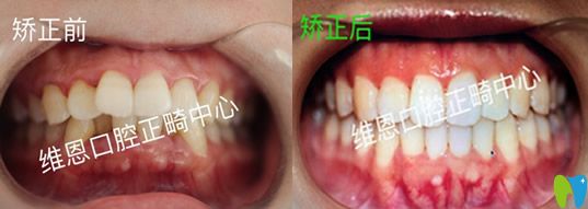 牙醫(yī)楊占娟怎么樣？看維恩口腔楊占娟真人案例
