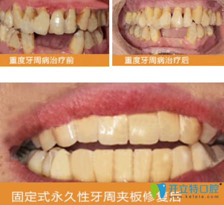 重度慢性牙周炎固定式性牙周加班修復前后對比圖