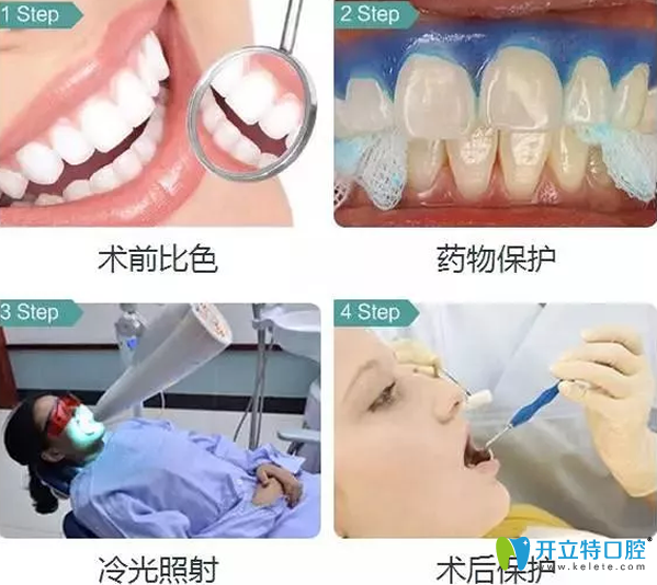 冷光美白牙齒的原理和步驟 冷光美白牙齒的原理和步驟