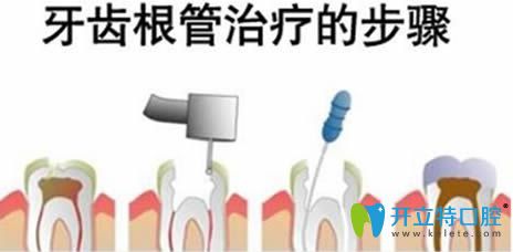 牙齒根管治療步驟圖