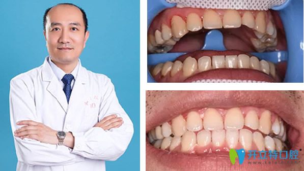 石家莊李向飛口腔冷光美白效果案例 石家莊李向飛口腔冷光美白效果案例