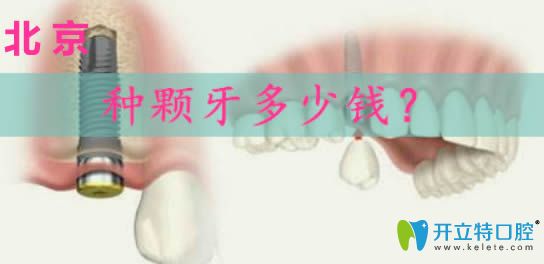 北京做種植牙多少錢?請(qǐng)看韓國(guó)奧齒泰和瑞士iti種植體價(jià)格表
