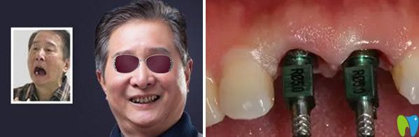 All-on-4 種植牙齒前后效果對比圖