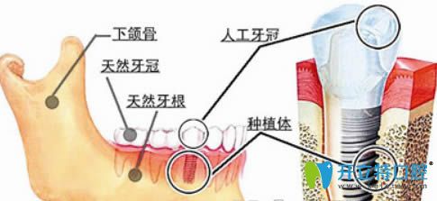重慶皇仕口腔種植牙圖解