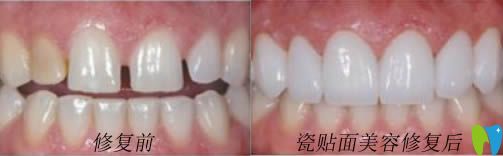 開立特網(wǎng)站牙齒貼面美容修復(fù)前后對(duì)比照