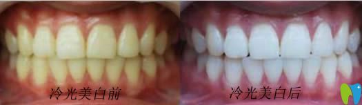 開立特牙齒美容修復(fù)前后對(duì)比圖