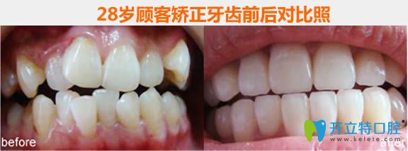 哈爾濱拜博口腔28歲隱適美矯正牙齒前后對(duì)比后效果照