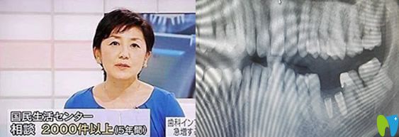 日本為什么停止種植牙？想知道日本禁止種植牙真相戳這里
