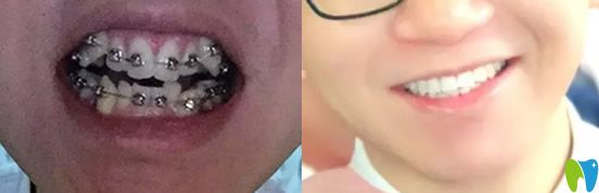 在合肥華美口腔做牙齒矯正前后的對(duì)比圖
