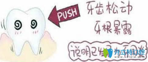 開立特牙齒松動怎么治療之牙周炎圖片