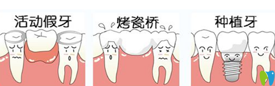 拔牙后多久可以鑲牙和鑲的牙齒有關(guān)
