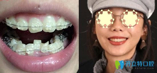  重慶整牙哪家？看重慶樂樂欣口腔牙齒矯正真人案例