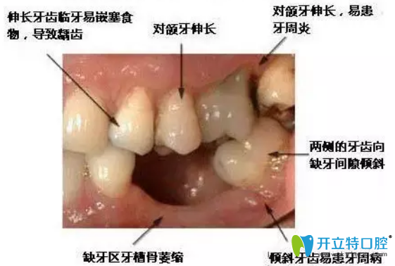 拔牙后鑲牙有沒有時(shí)間？