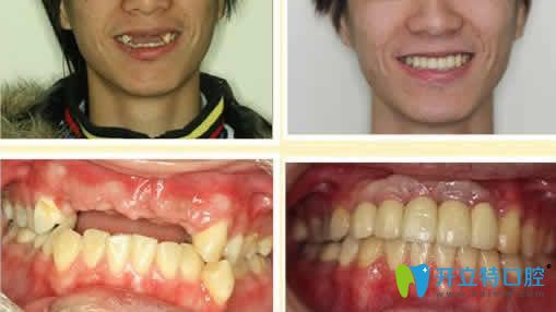 長沙雅美口腔李偉即可種植牙效果圖