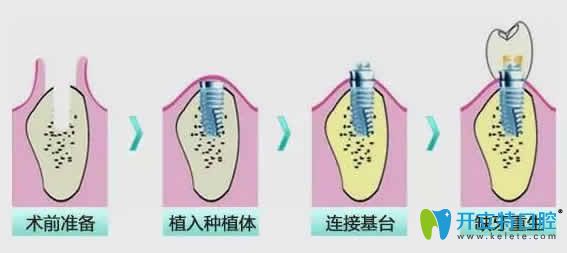  全面揭秘：即刻種植牙步驟及2024全國種植牙價格表