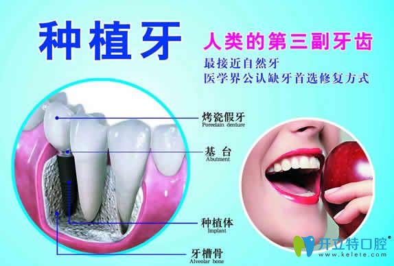 一顆進(jìn)口種植牙要多少錢？2024全新國內(nèi)種植牙價格表曝出
