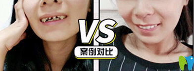 牙博士口腔怎么樣？看牙齒全瓷冠修復案例前后對比圖