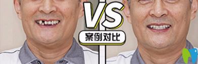 牙博士口腔好嗎？看牙博士種牙案例效果