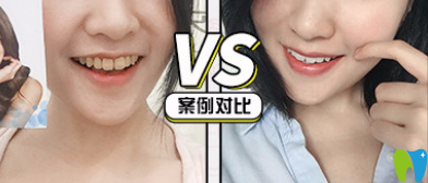 青島牙博士口腔好不好？看牙齒美白真人案例來驗證