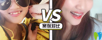 青島牙博士口腔靠譜嗎？牙博士口腔半隱形牙齒矯正案例來證明