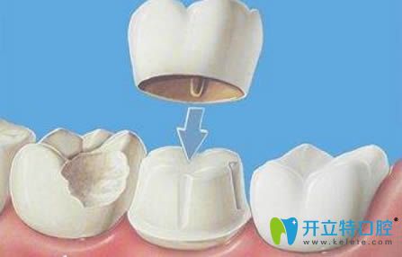 開(kāi)立特口腔網(wǎng)烤瓷牙套圖片