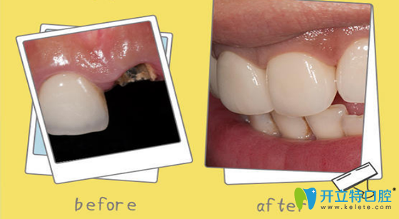 歡樂仁愛口腔單顆牙缺失種植案例 歡樂仁愛口腔單顆牙缺失種植案例