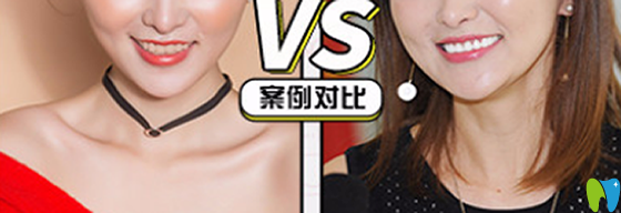 在沈陽歡樂仁愛口腔做牙齒瓷貼面治療前后對比案例 在沈陽歡樂仁愛口腔做牙齒瓷貼面治療前后對比案例