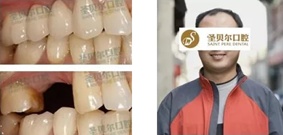 種植牙疼不疼要多久 大連圣貝爾口腔做過種植牙的人談體會(huì)