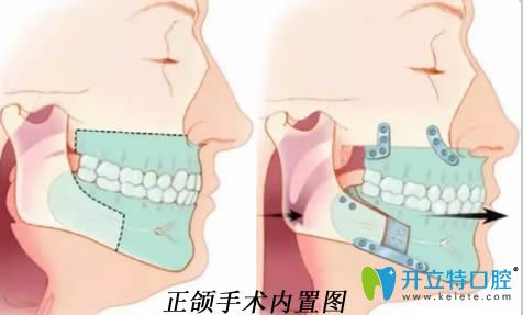 解答正頜手術(shù)的費(fèi)用是多少錢和什么情況需要做口腔正頜