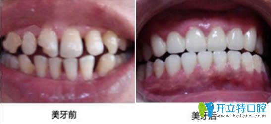 廣州置略馬瀧齒科鄒波全瓷牙6顆修復(fù)真人照片