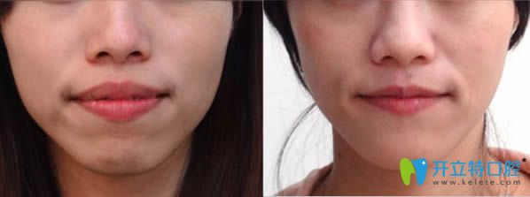 成人凸嘴矯正案例及帶牙套前后對比照