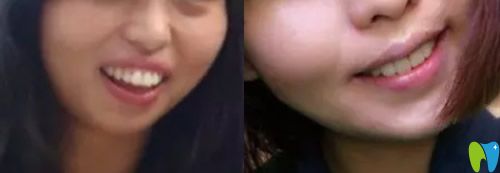 重慶牙科哪家好，看美維口腔齙牙矯正案例效果圖