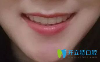 結(jié)束正畸，戴保持器圖片